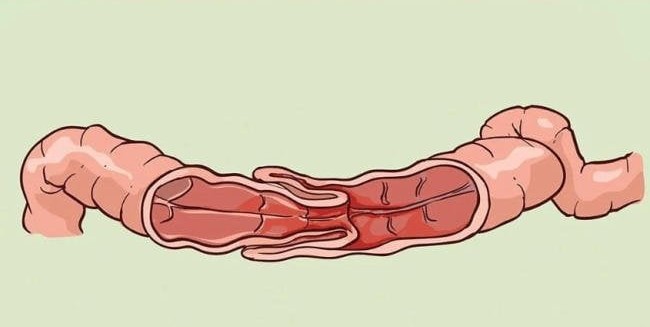 Bài tập phòng và hỗ trợ phục hồi cho bệnh nhân lồng ruột- Ảnh 1. Bài tập phòng và hỗ trợ phục hồi cho bệnh nhân lồng ruột- Ảnh 1.